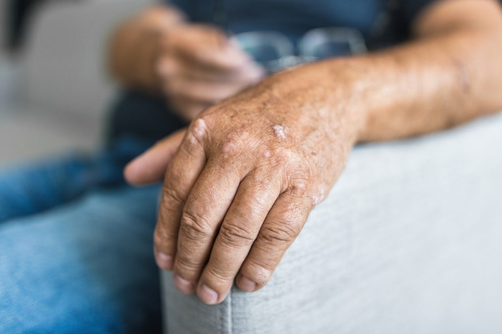Physical Therapy for Every Type of Arthritis AdobeStock 511026677 physical therapy for every type of arthritis arthritis
